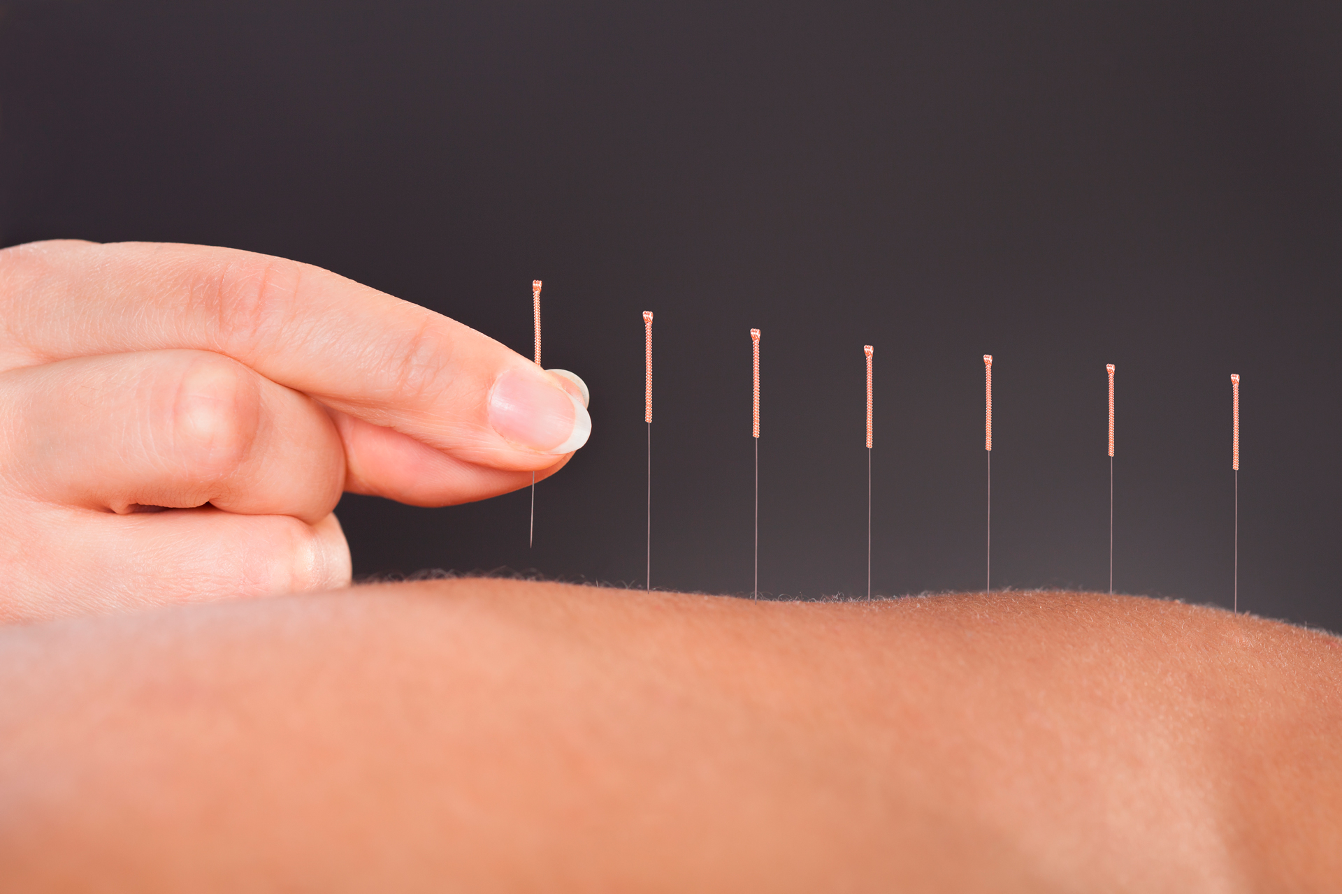 Acupuncture needles being inserted into skin during treatment at Plaza Physiotherapy in Burnaby